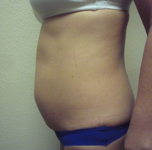 Tummy Tuck