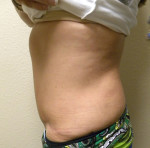 Tummy Tuck