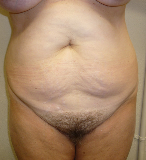 Tummy Tuck