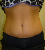 Tummy Tuck