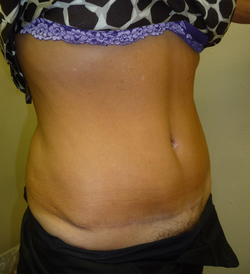 Tummy Tuck