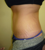 Tummy Tuck