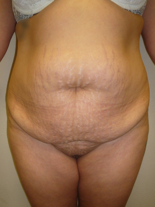 Tummy Tuck