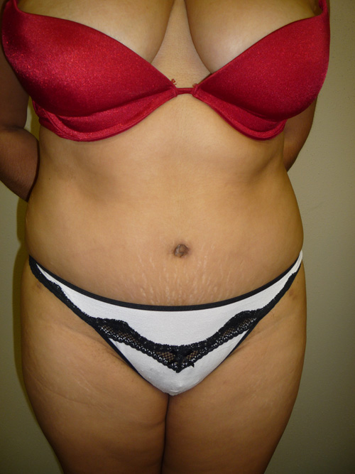 Tummy Tuck