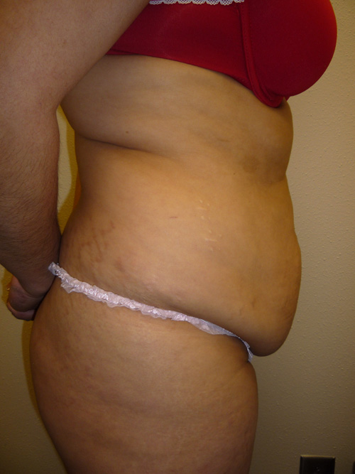 Tummy Tuck