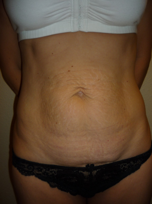 Tummy Tuck