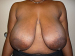 Breast Reduction