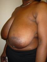 Breast Reduction