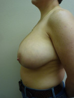 Breast Reduction