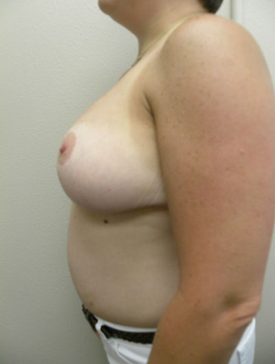 Breast Reduction