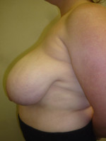 Breast Reduction