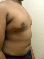 Gynecomastia