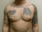 Gynecomastia