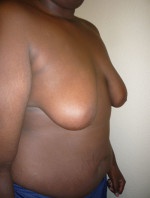 Gynecomastia