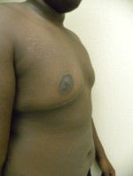 Gynecomastia