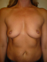 Breast Augmentation