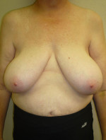 Breast Reconstruction