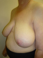 Breast Reconstruction