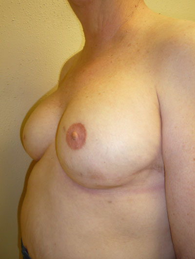 Breast Reconstruction