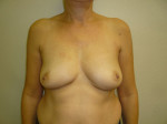 Breast Reconstruction