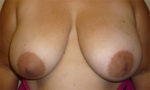 Breast Reconstruction