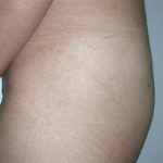 Fat Transfer to Buttocks