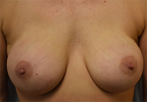 Nipple Sparing Mastectomies & Reconstruction