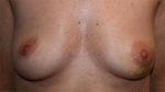 Nipple Sparing Mastectomies & Reconstruction