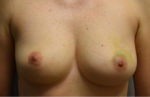 Breast Reconstruction