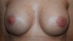 Nipple Sparing Mastectomies & Reconstruction