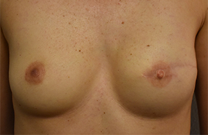 Breast Reconstruction