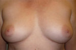 Nipple Sparing Mastectomies & Reconstruction