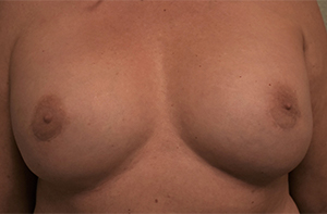 Nipple Sparing Mastectomies & Reconstruction