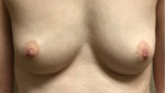 Nipple Sparing Mastectomies & Reconstruction