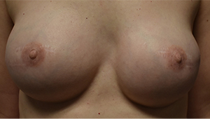 Nipple Sparing Mastectomies & Reconstruction