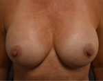 Nipple Sparing Mastectomies & Reconstruction