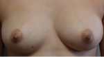 Nipple Sparing Mastectomies & Reconstruction