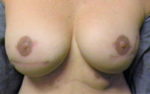 Nipple Sparing Mastectomies & Reconstruction