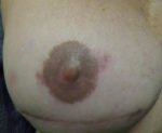 Nipple Sparing Mastectomies & Reconstruction