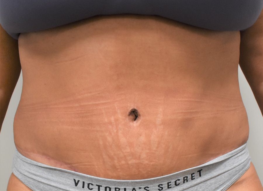 Tummy Tuck