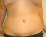 Tummy Tuck