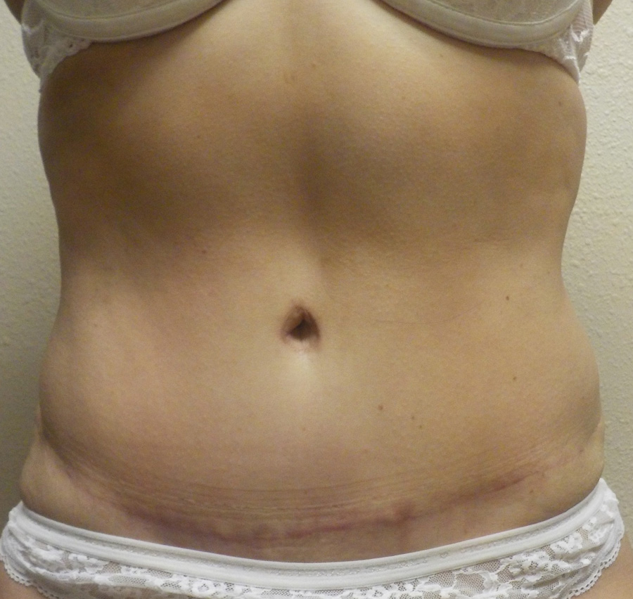 Tummy Tuck