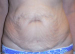 Tummy Tuck