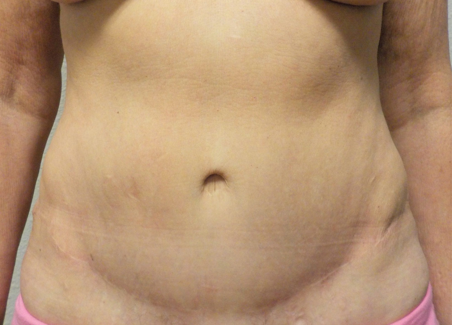 Tummy Tuck