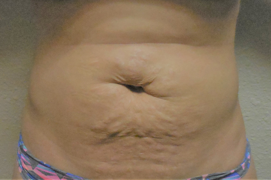 Tummy Tuck