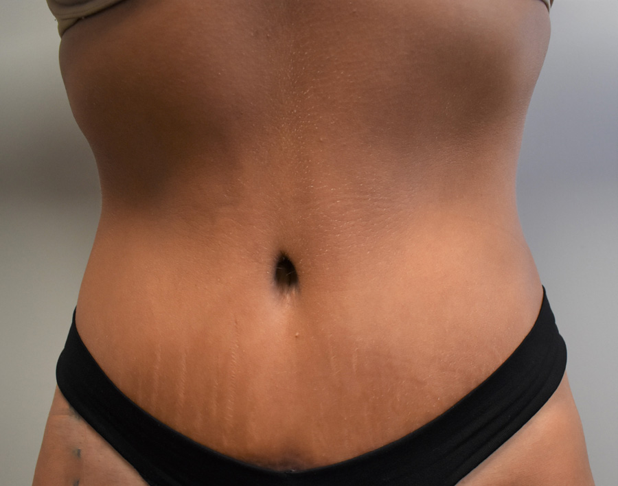 Tummy Tuck