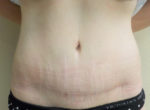 Tummy Tuck