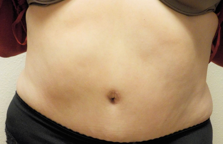 Tummy Tuck