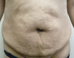 Tummy Tuck