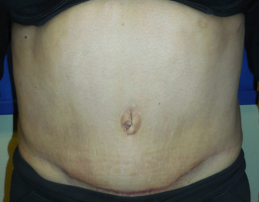 Tummy Tuck